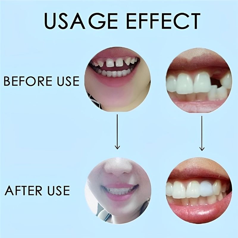 [BARU!ABMK】 2 Pasang, Kembalik - Teeth Whitening For Braces ulasan dan harga